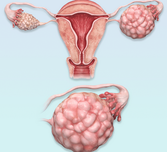 Polikistik Over Sendromu (PCOS) Nedir?